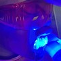 Teeth Whitening