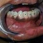 Teeth Whitening