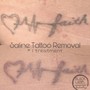 Tattoo Removal