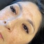 Anti-aging Chemical peel