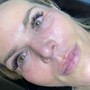 Dermaplaning Facial