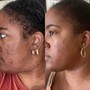 MicroNeedling