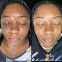 Microdermabrasion