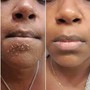 Microdermabrasion