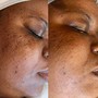 Back Facial with Acne