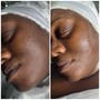 Back Facial with Acne