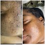 The Detox-Acne Facial Treatment