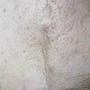 Microdermabrasion