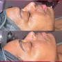 Back Facial Treatment