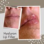 Needless Lips filler 1ml