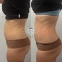 Full Leg Cellulite Treatment