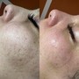 Microdermabrasion