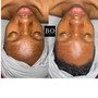 Blemish AND Balance Facial