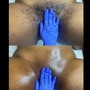 Ingrown hair Vajacial w/ full Brazilian wax