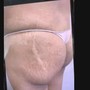 RF Tightening and Cellulite Treatment w/ Butt Lift