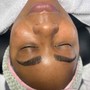 Microdermabrasion