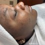 Microdermabrasion