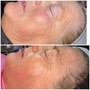 BOTOX GLOWTOX FACIAL