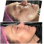 Dermaplaning