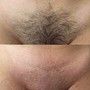 Chest Peel