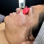 Dermaplane Facial