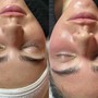 Microdermabrasion