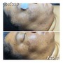 Level 2 Glycolic peel