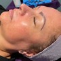 Microdermabrasion