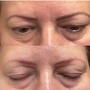 Permanent Makeup Removal