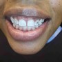 Teeth Whitening