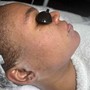 Microdermabrasion Facial