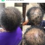 Hair Restoration Package