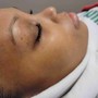 Exfoliating Microdermabrasion Treatment