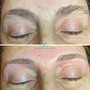 Microdermabrasion