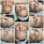 Acne Fighter High Frequency Facial