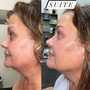 “The Works” Neurotris microcurrant face lift package of 3