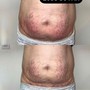 Cryo fat freezing and reduction