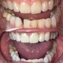 Professional Teeth Whitening