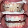 Professional Teeth Whitening