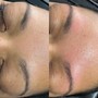 Acne Treatment Facial