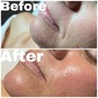 MicroNeedling Face + Neck (Includes post-procedure kit)