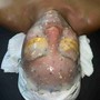 Teen Acne Facial