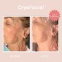 Demo Day Cryoskin Slimming or Toning and Cryo Facial