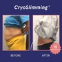 Demo Day Cryoskin Slimming or Toning and Cryo Facial