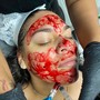 PRP Vampire Facial