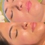 Oxygen Facial