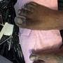 Big Toe reconstruction with acrylic