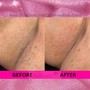 Underarm Brightening Treatment