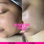 Acne Facial