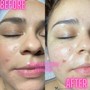 Acne Facial